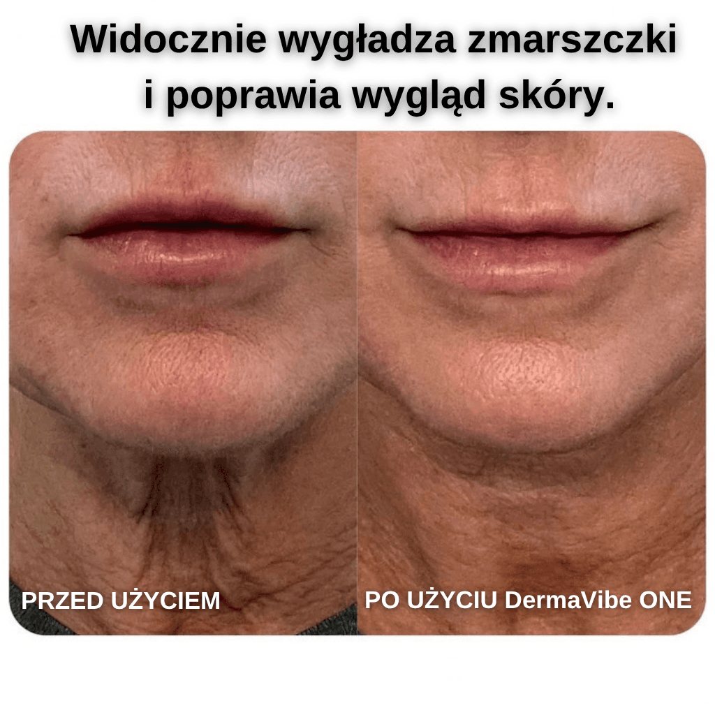 DermaVibe ONE - PRECYZYJNY STYMULATOR  DO WIELOPOZIOMOWEGO ODMŁADZANIA SKÓRY